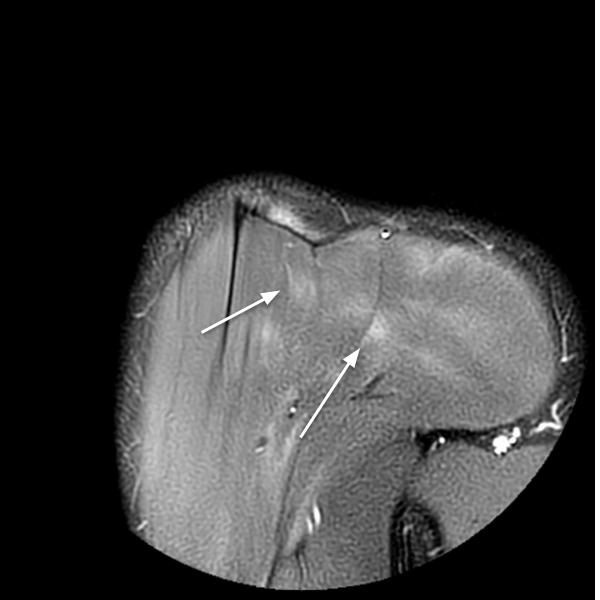 RM spalla edema muscolare 2